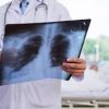 3 Cara Cegah Pnemonia Pada Anak